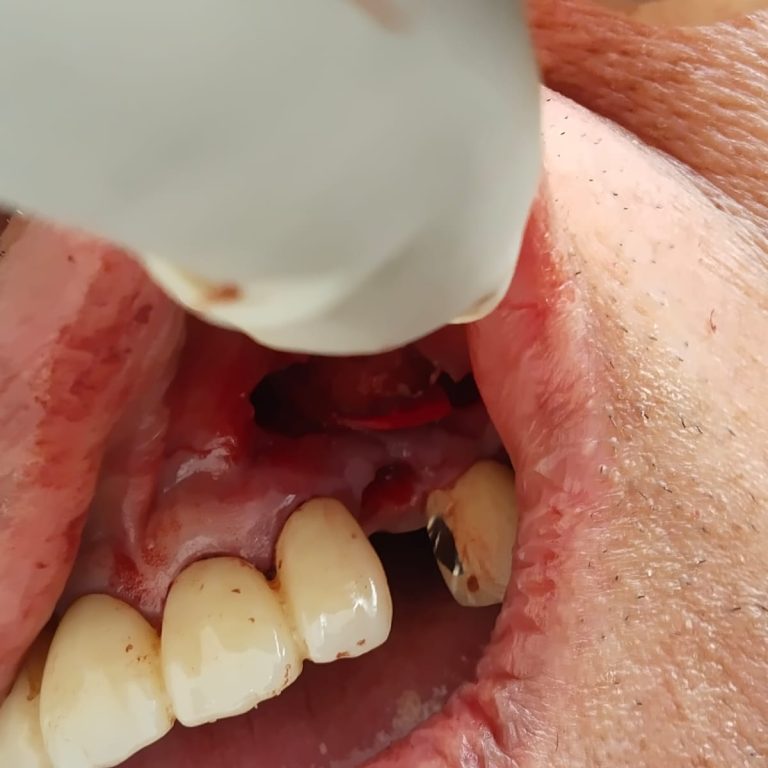 best wisdom tooth extraction doctor in dhaka