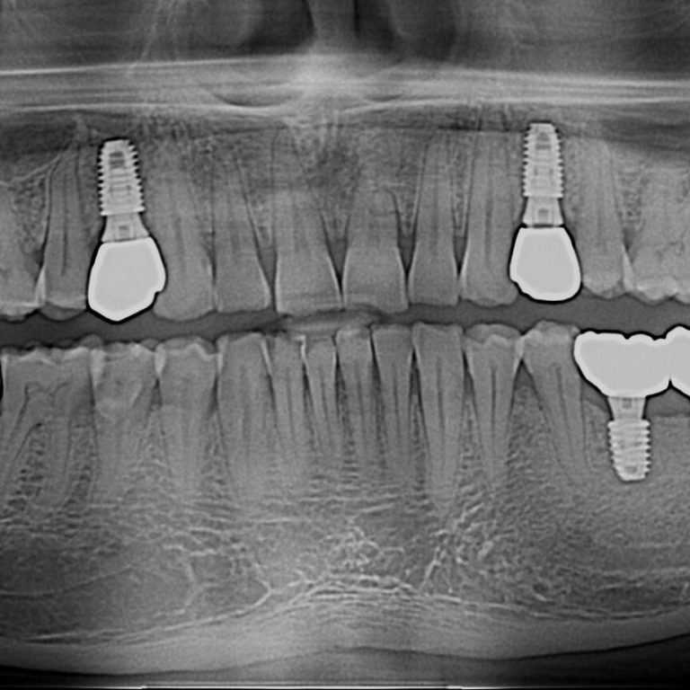 Top dental implant in Dhaka