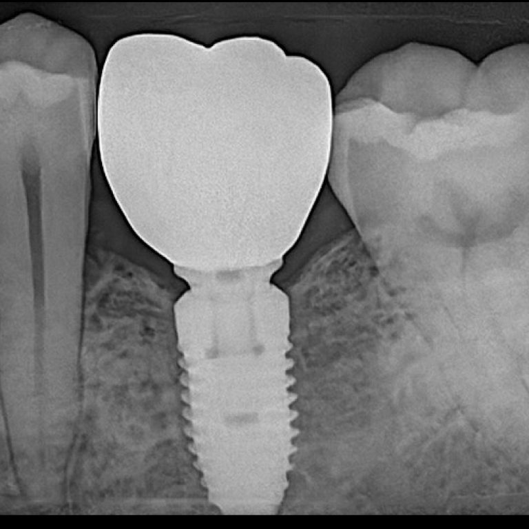 Best dental implant clinic in Dhaka at Banani for missing teeth replacement