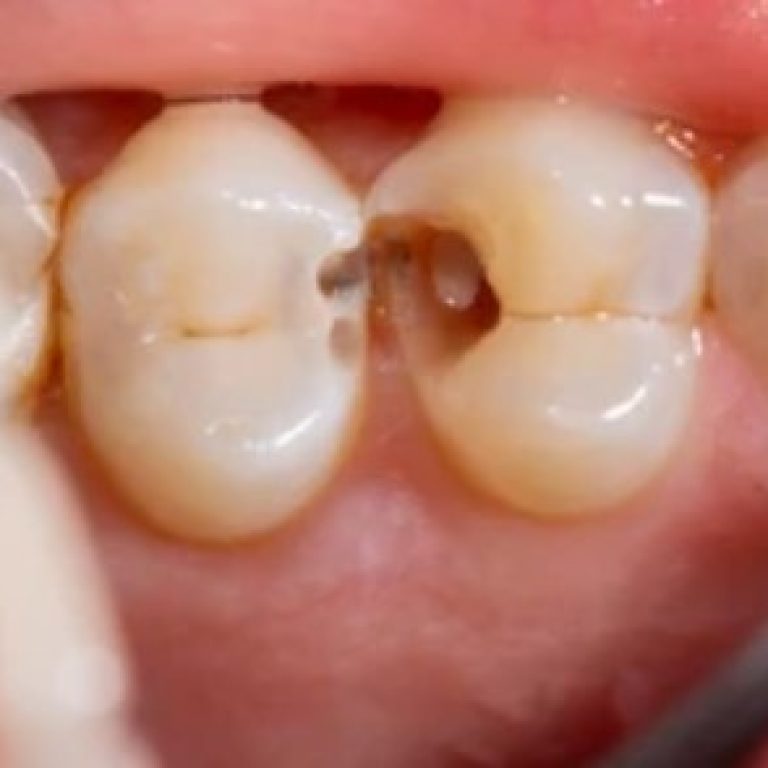 Dental Filling
