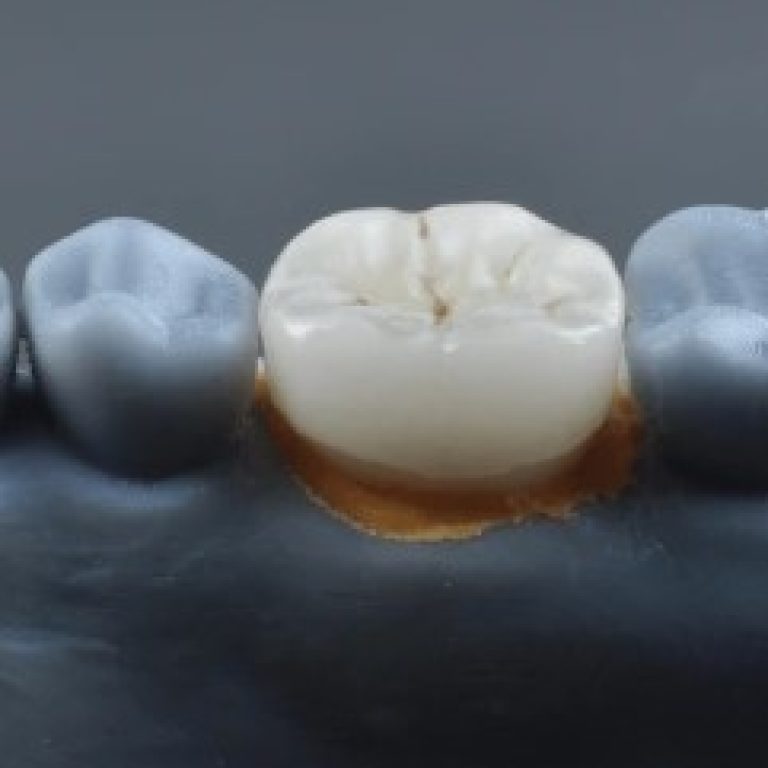 dental crown - a future trouble