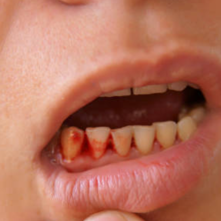 gum bleeding
