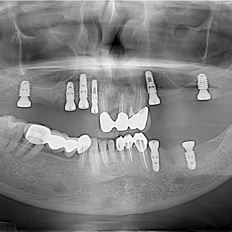 Multiple Implant : top dental Implant center in Dhaka