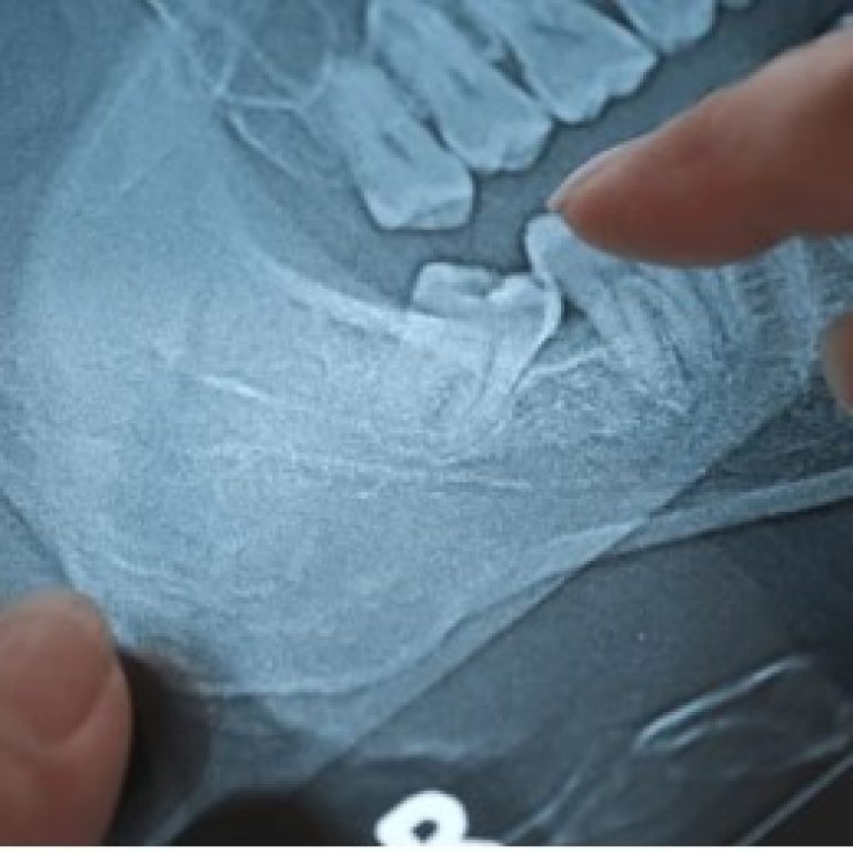 wisdom tooth extraction
